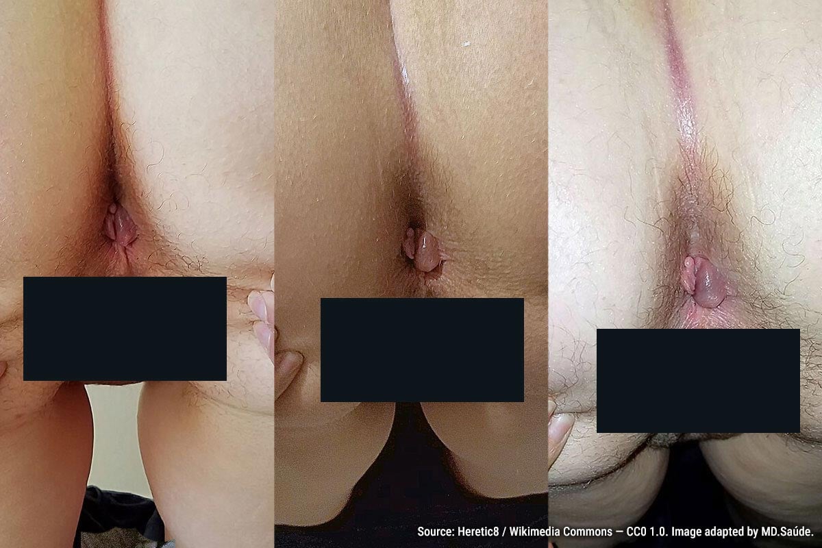 External hemorrhoid with no signs of complications. Adjacent anal skin tag.