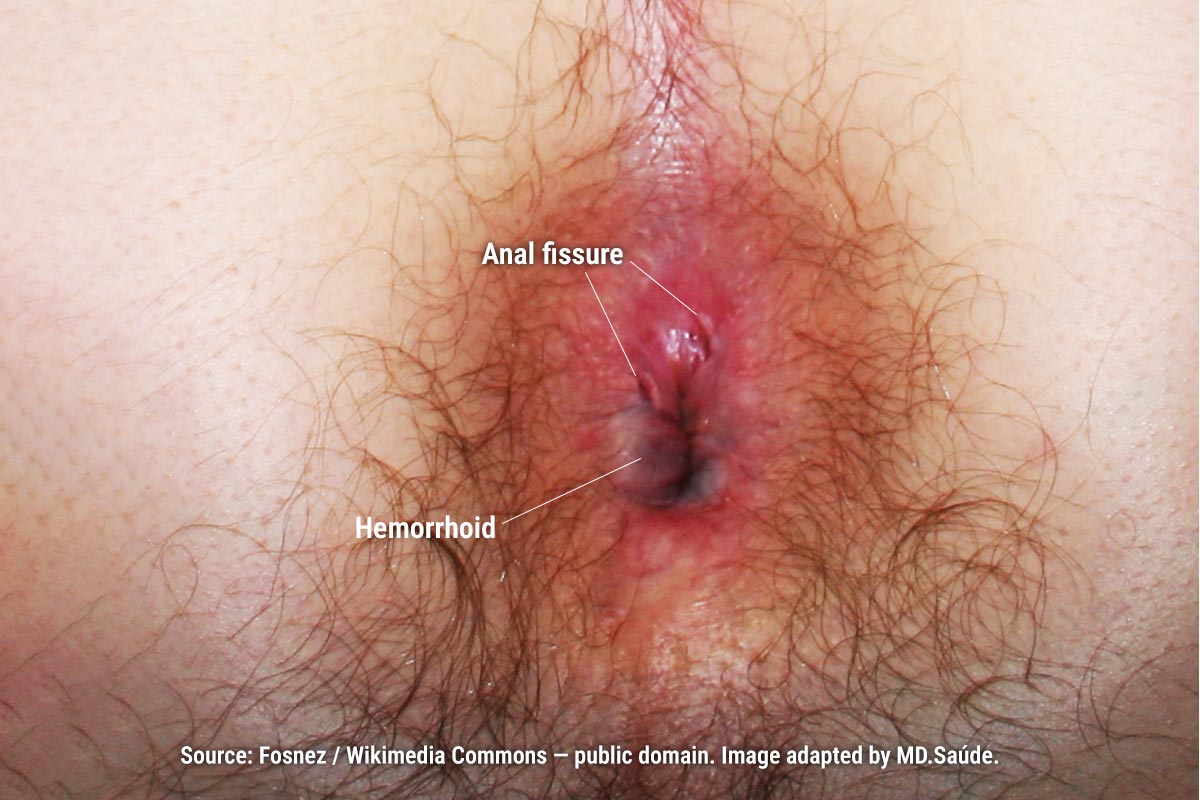Thrombosed external hemorrhoid, visible as a purplish nodule at the anal margin. Two surrounding anal fissures.