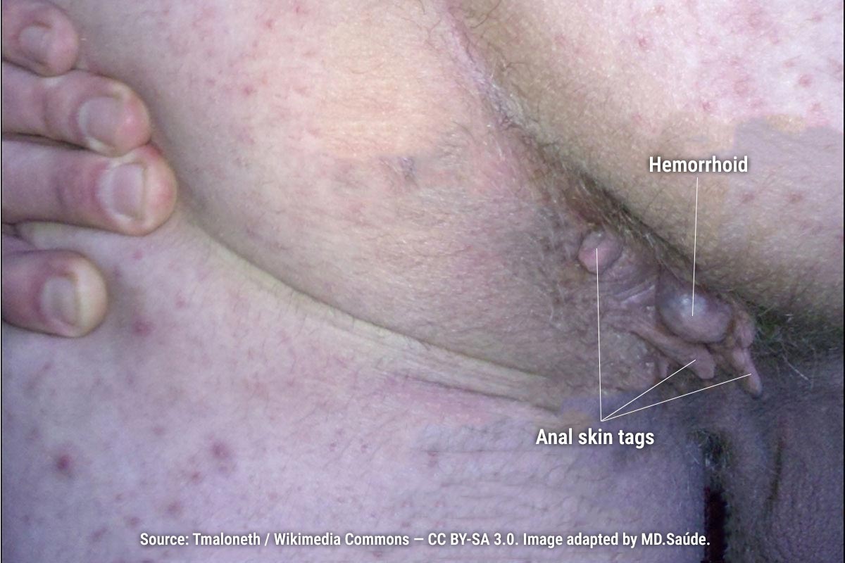 External hemorrhoid with several surrounding anal skin tags.