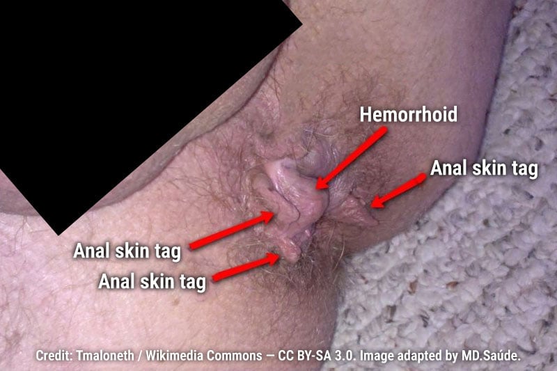 External hemorrhoid with several surrounding anal skin tags.