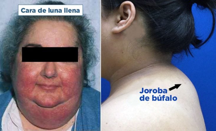 Facie cushingoide e joroba de búfalo