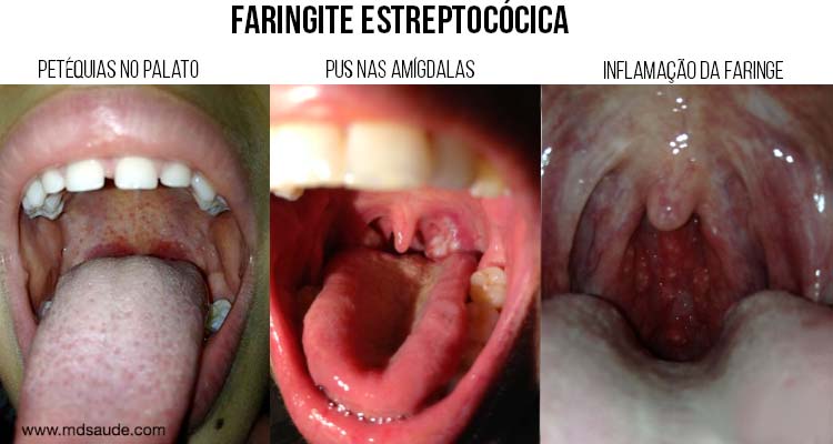 Fotos de Faringite bacteriana