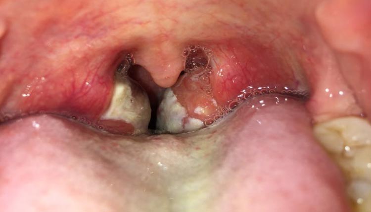 Faringitis estreptocócica con pus en las amígdalas