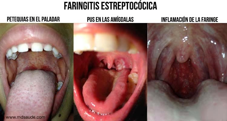 Faringitis causada por Streptococcus pyogenes
