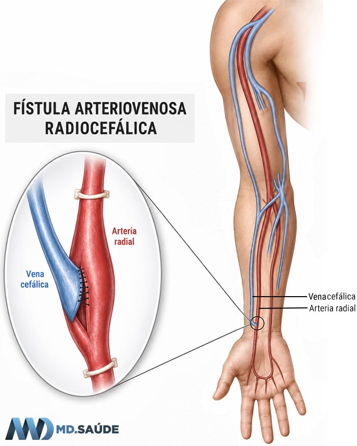FAV radiocefálica, uno de los tipos de acceso vascular utilizados en la hemodiálisis