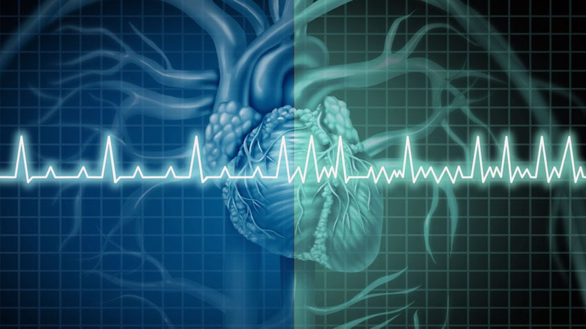 Fibrilación auricular: qué es, tratamiento y riesgo de ictus