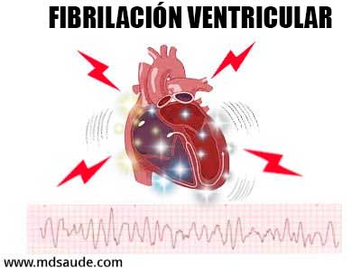 fibrilación ventricular