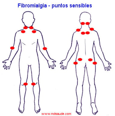 fibromialgia puntos