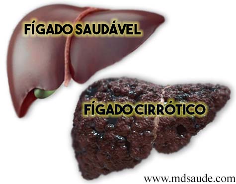 Fígado cirrótico