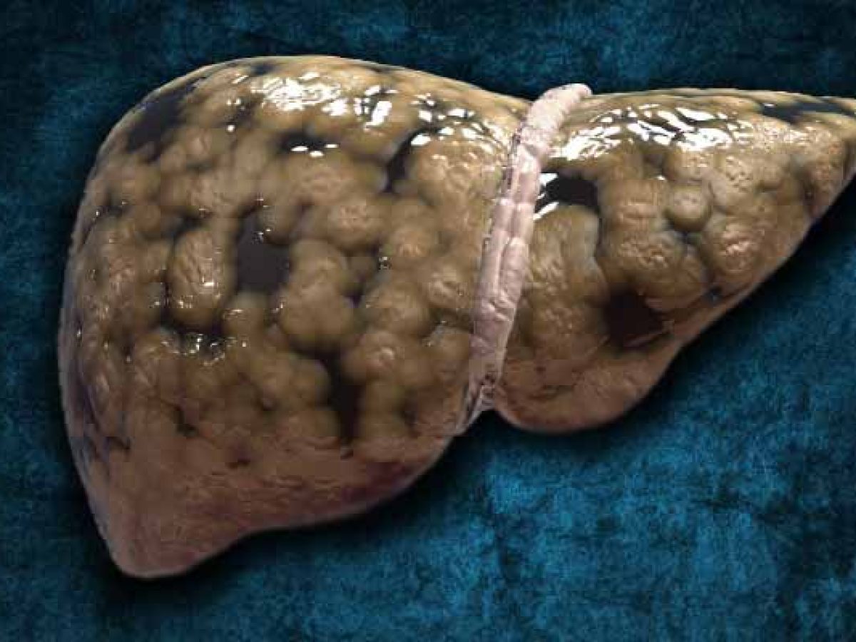 O que é esteatose hepática (gordura no fígado)?
