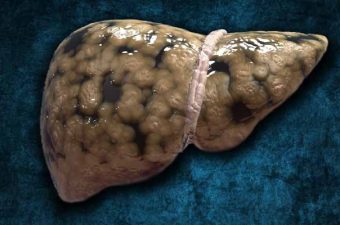 ESTEATOSIS HEPÁTICA (hígado graso) – Causas, síntomas y tratamiento