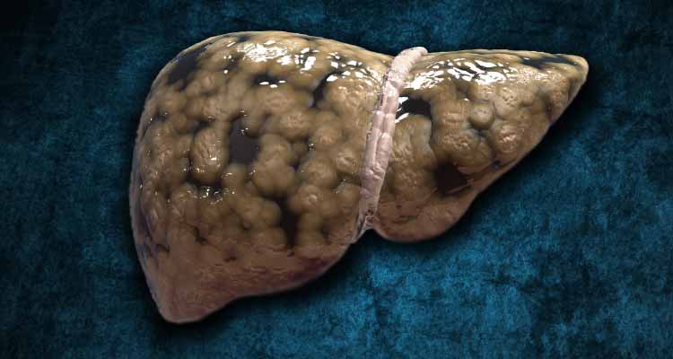 Hígado graso (esteatosis hepática): síntomas y tratamiento