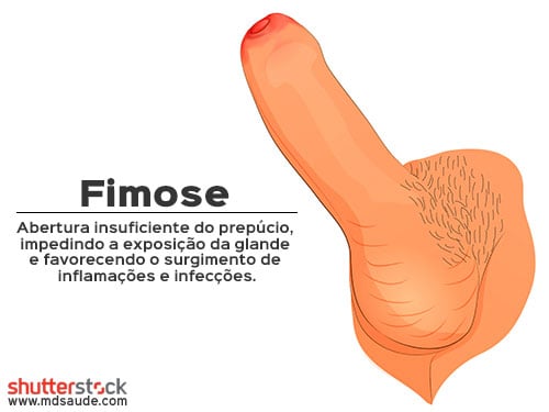 Fimose - ilustração
