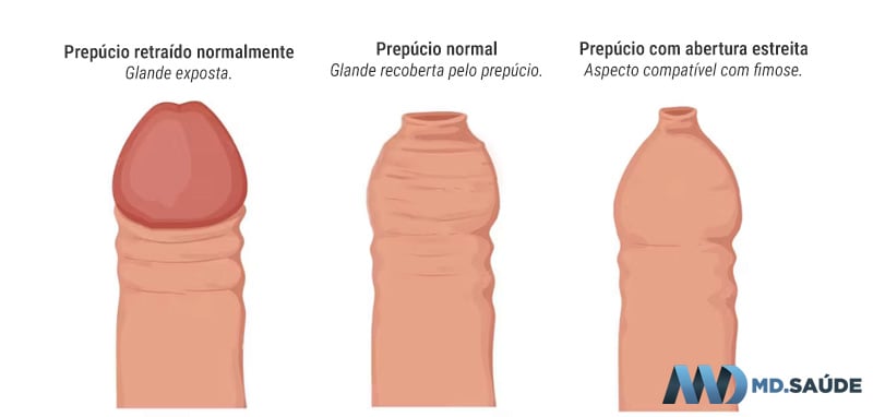 Aspectos esquemáticos do prepúcio em retração normal, em posição habitual e com abertura estreita compatível com fimose.