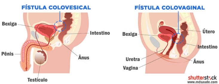Fístulas provocadas por diverticulite aguda
