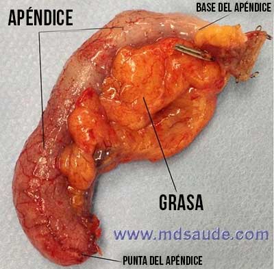  Apendicectomía