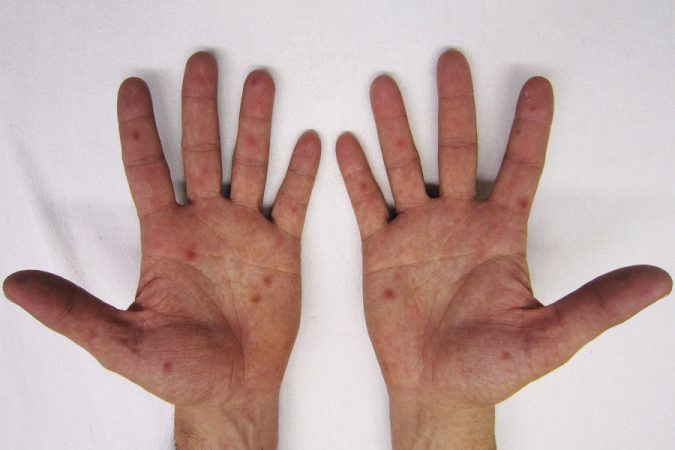 Vermelhas mãos dolorosas pés manchas nos e