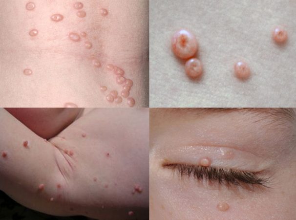 Molusco Contagioso – sintomas, tratamento e fotos 2 Imagens das lesões do molusco contagioso