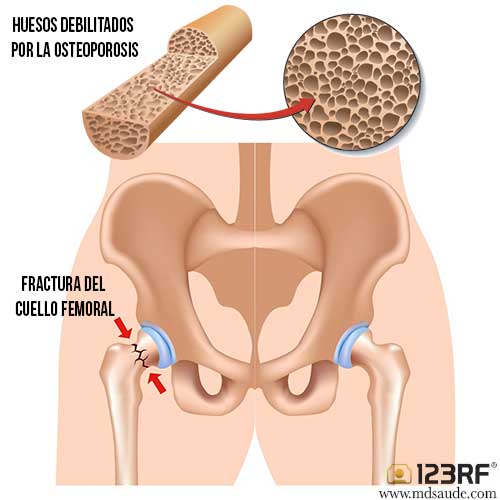 Osteoporosis: fractura de la cadera