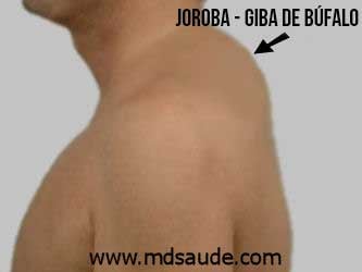 Joroba - Giba de búfalo