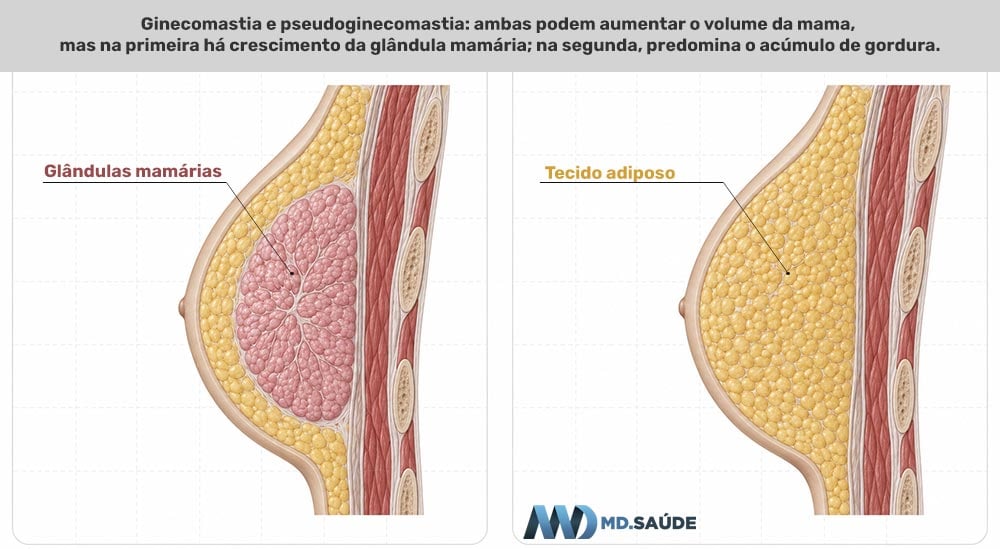Ilustração em corte lateral compara ginecomastia, com aumento do tecido glandular atrás da aréola, e pseudoginecomastia, causada principalmente por acúmulo de gordura no tórax.