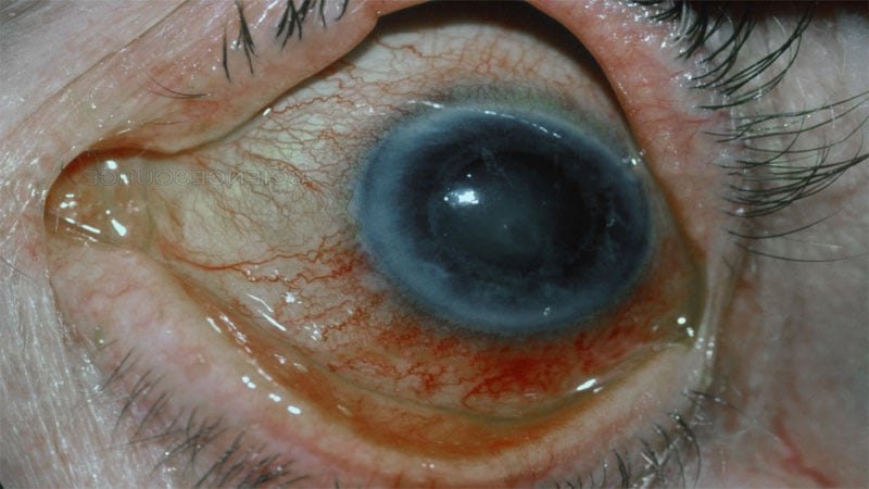 Glaucoma de ângulo fechado - Olhos vermelhos, intensa dor, edema da córnea, pupila dilatada e lacrimejamento.