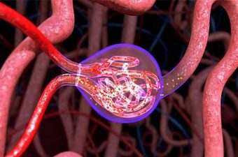 Glomerulonefrite - néfron