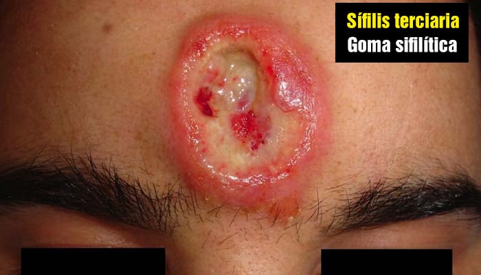 Goma sifilítica en la cara - Sífilis terciaria