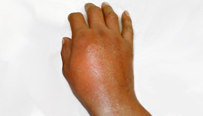 Artritis gotosa en la mano