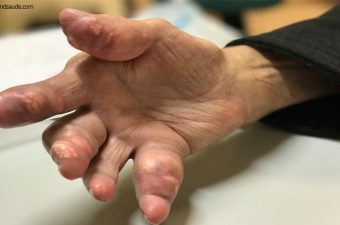 GOTA (artrite gotosa) – Causas, sintomas e tratamento