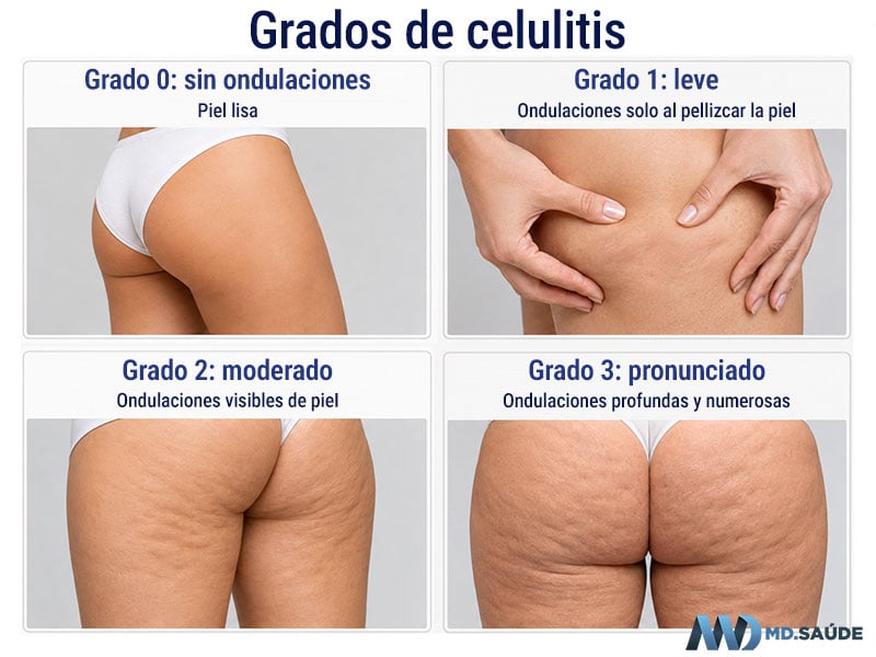 Grados de celulitis