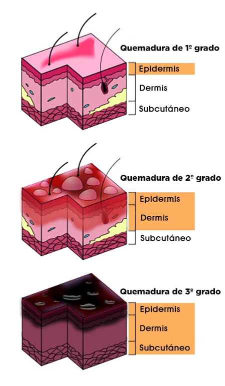 Quemaduras: grados, imágenes y tratamiento | MD.Saúde (2023)