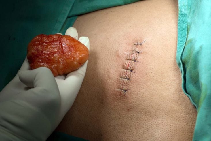 Lipoma grande en la espalda extirpado quirúrgicamente
