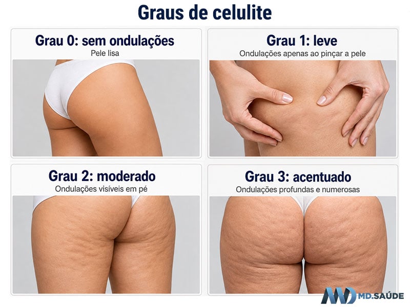 Graus de celulite