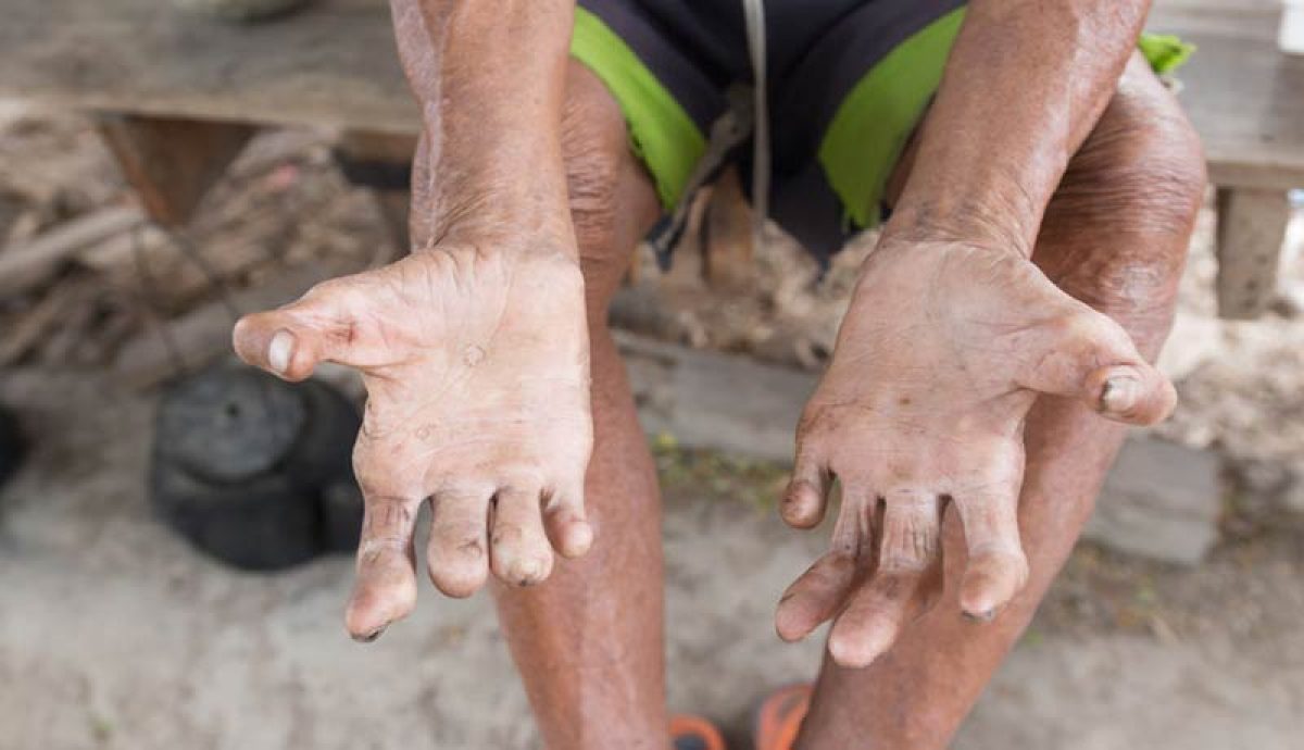 HANSENÍASE SINTOMAS E COMO FICA O CORPO TRANSMISSÃO