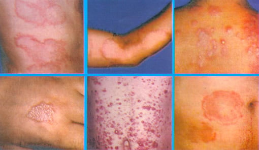 Lesões da lepra hipopigmentadas ou avermelhadas.