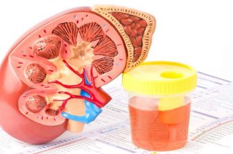 HEMATURIA – Causas de sangre en la orina