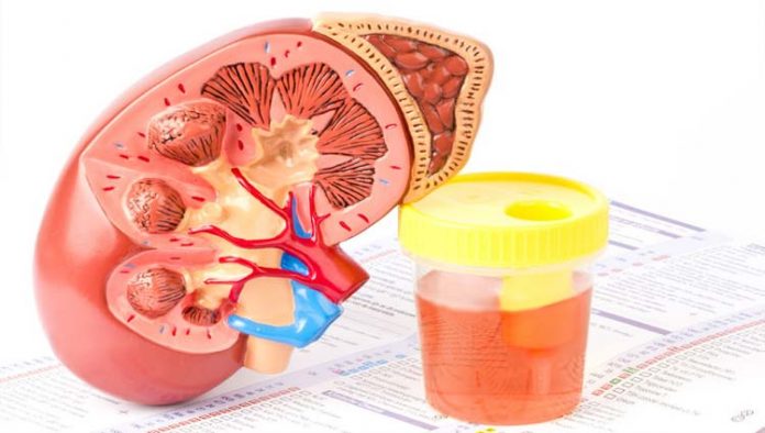 hematuria-sangue-na-urina Hematúria