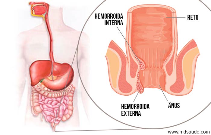 Hemorroida externa e hemorroida interna