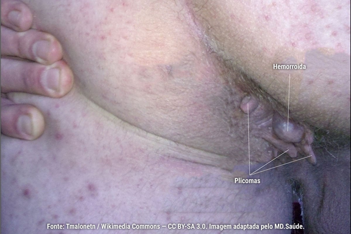 Hemorroida externa com vários plicomas ao redor