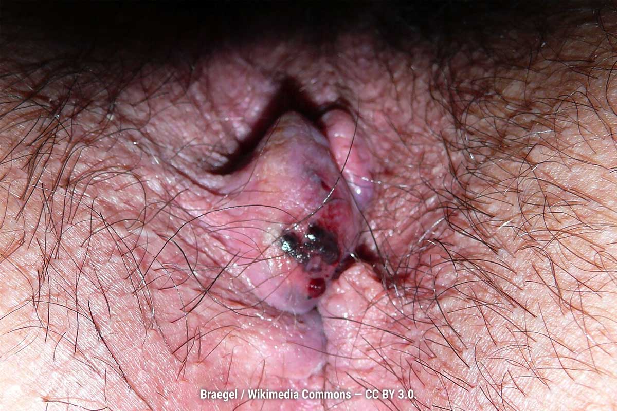Inflamed external hemorrhoid with adherent blood clots, indicating recent bleeding.