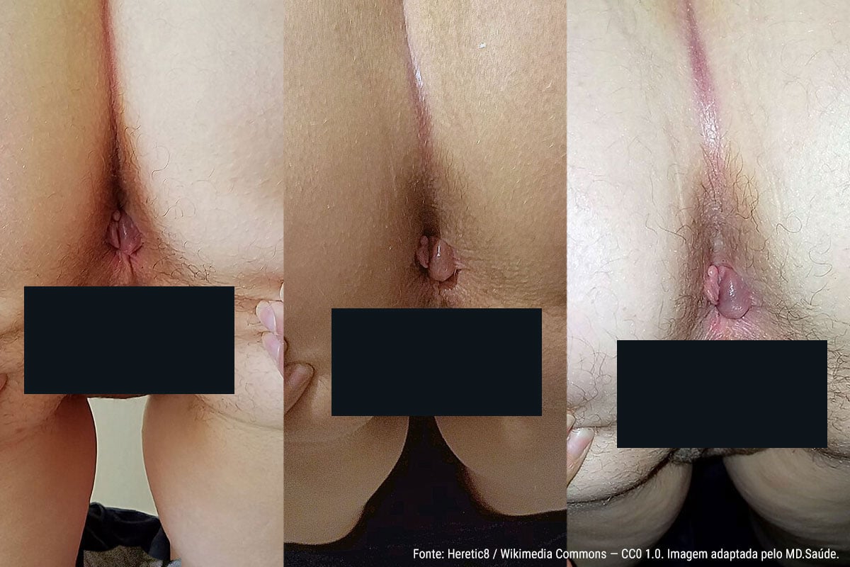 Hemorroida externa sem sinais de complicação. Plicoma adjacente.