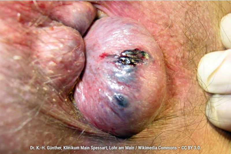 Thrombosed external hemorrhoid, characterized by a tense, purplish nodule at the anal margin. The skin overlying the hemorrhoid is stretched and eroded, causing bleeding.