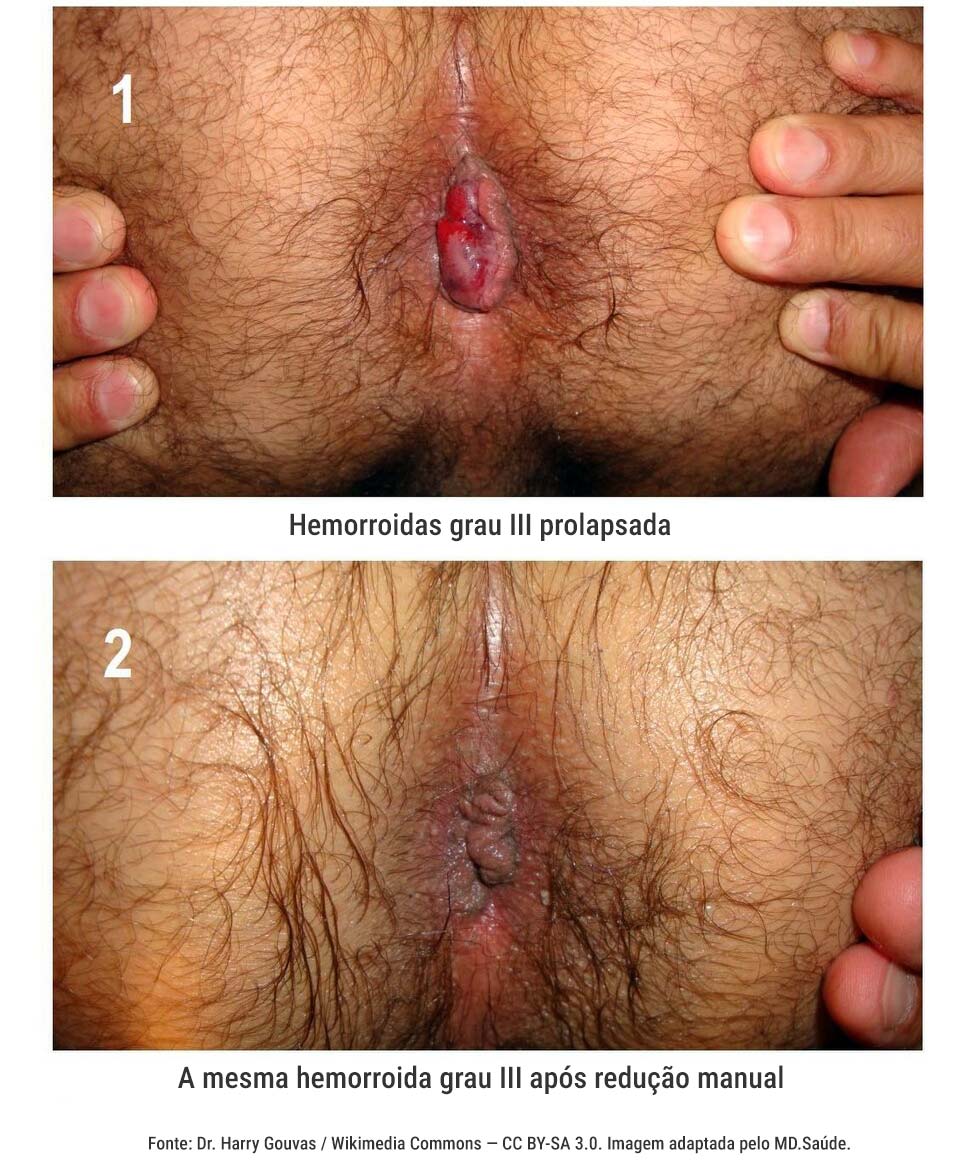 Hemorroida interna grau III antes e depois da redução manual
