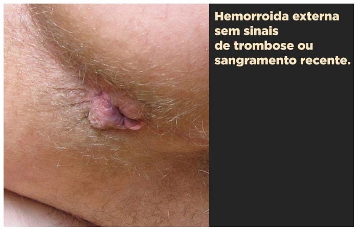 Hemorroida externa