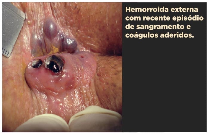 Hemorroida com coágulos