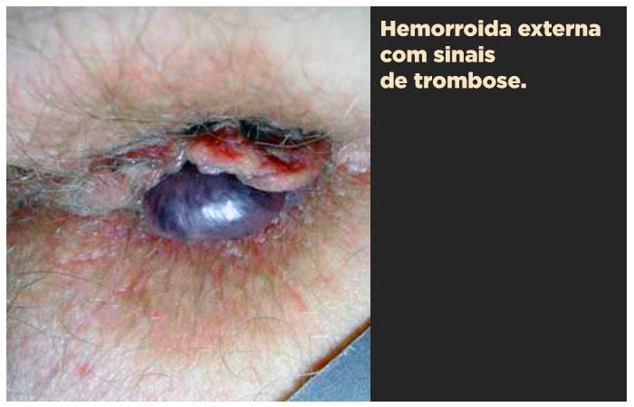 Hemorroida com trombose