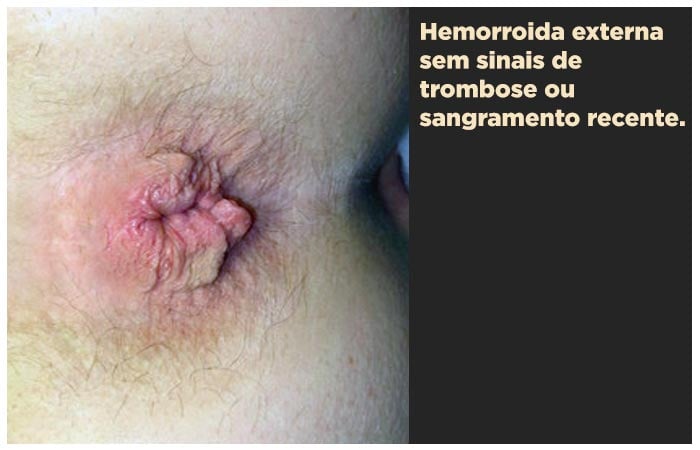 Hemorroida externa
