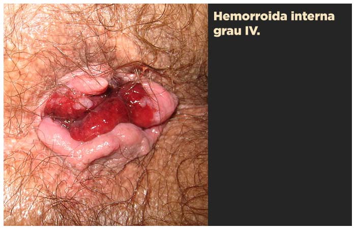 Hemorroida interna grau IV