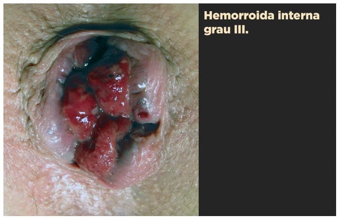 Hemorroida interna grau III
